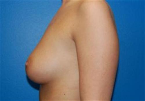 Breast Augmentation Before and After | SGK Plastic Surgery