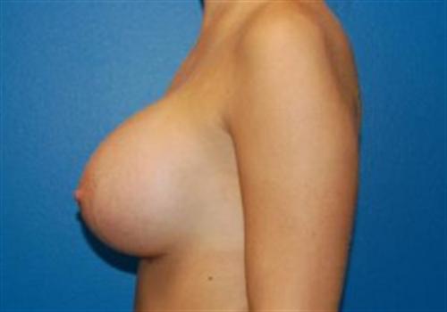 Breast Augmentation Before and After | SGK Plastic Surgery