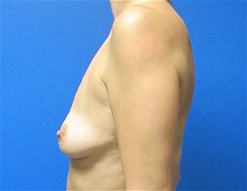 Breast Augmentation Before and After | SGK Plastic Surgery