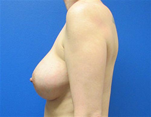 Breast Augmentation Before and After | SGK Plastic Surgery