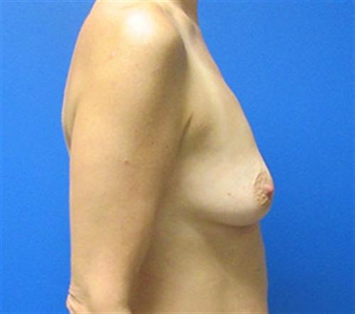 Breast Augmentation Before and After | SGK Plastic Surgery