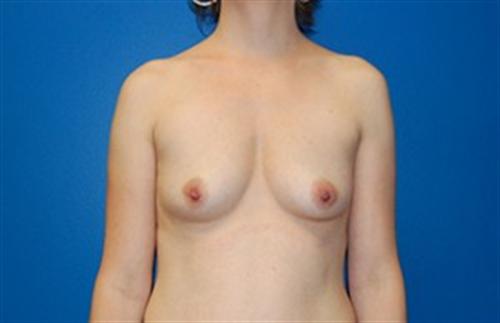 Breast Augmentation Before and After | SGK Plastic Surgery