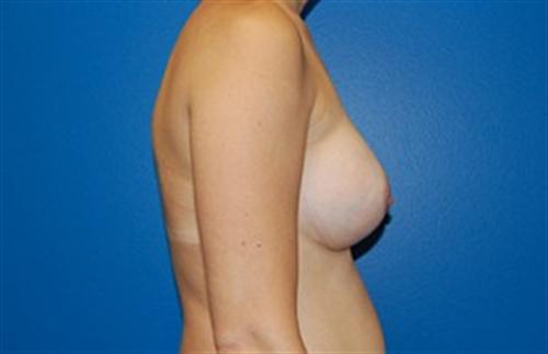 Breast Augmentation Before and After | SGK Plastic Surgery