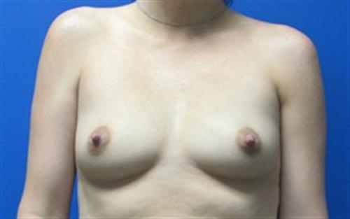 Breast Augmentation Before and After | SGK Plastic Surgery