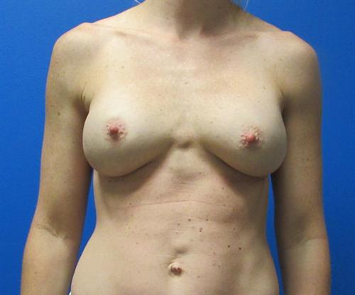 Breast Augmentation Before and After | SGK Plastic Surgery