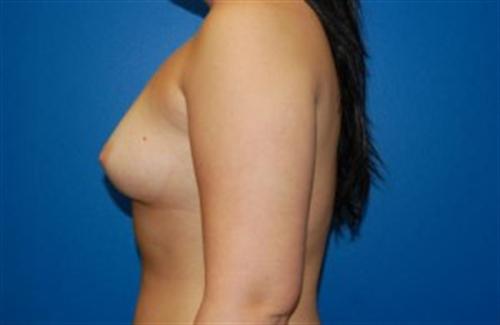 Breast Augmentation Before and After | SGK Plastic Surgery