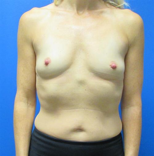 Breast Augmentation Before and After | SGK Plastic Surgery