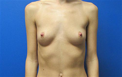 Breast Augmentation Before and After | SGK Plastic Surgery