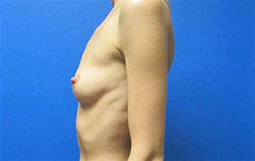 Breast Augmentation Before and After | SGK Plastic Surgery