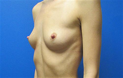 Breast Augmentation Before and After | SGK Plastic Surgery