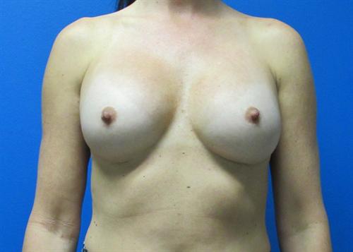 Breast Augmentation Before and After | SGK Plastic Surgery