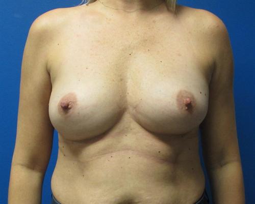 Breast Augmentation Before and After | SGK Plastic Surgery