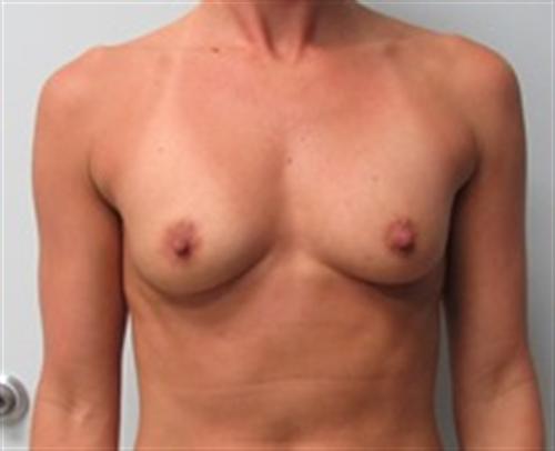 Breast Augmentation Before and After | SGK Plastic Surgery