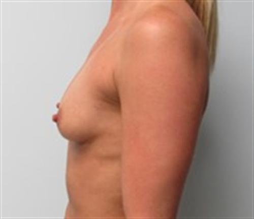 Breast Augmentation Before and After | SGK Plastic Surgery