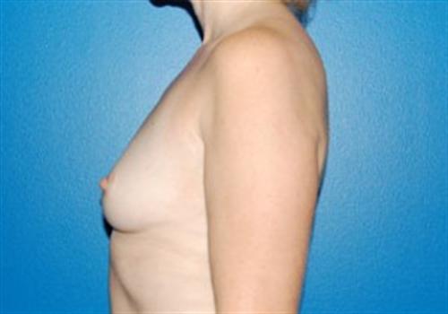 Breast Augmentation Before and After | SGK Plastic Surgery