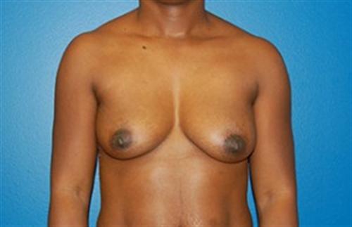 Breast Augmentation Before and After | SGK Plastic Surgery