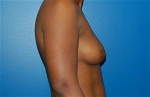 Breast Augmentation Before and After | SGK Plastic Surgery