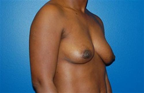 Breast Augmentation Before and After | SGK Plastic Surgery