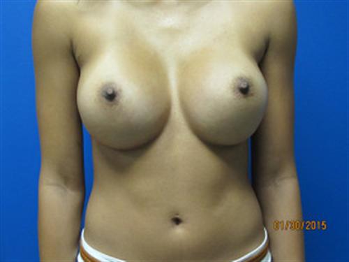 Breast Augmentation Before and After | SGK Plastic Surgery