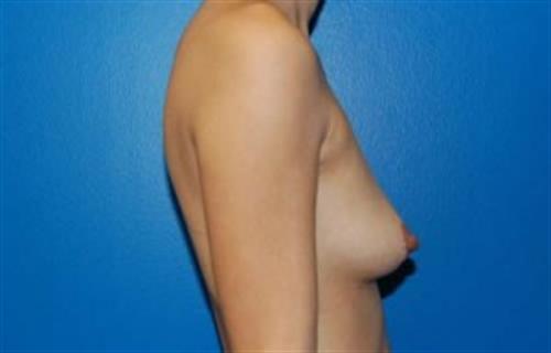 Breast Augmentation Before and After | SGK Plastic Surgery