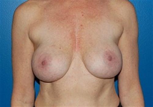 Breast Augmentation Before and After | SGK Plastic Surgery