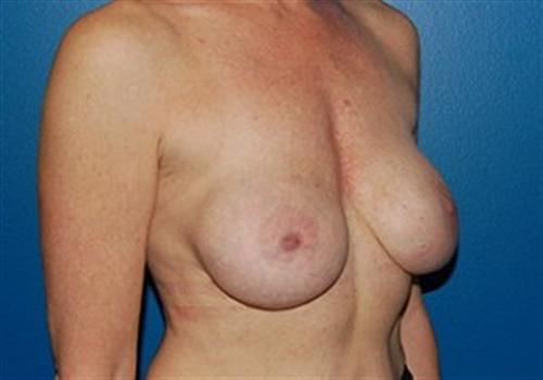 Breast Augmentation Before and After | SGK Plastic Surgery