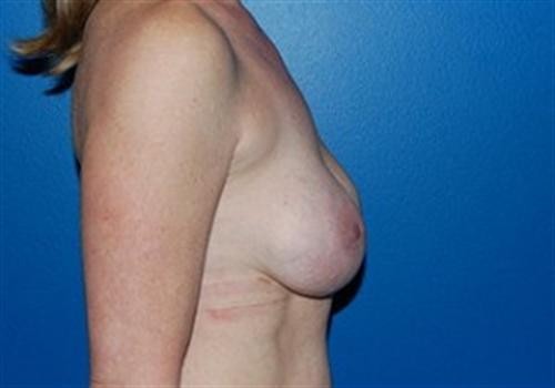 Breast Augmentation Before and After | SGK Plastic Surgery