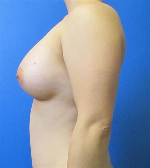 Breast Augmentation Before and After | SGK Plastic Surgery