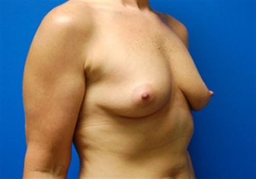 Breast Augmentation Before and After | SGK Plastic Surgery