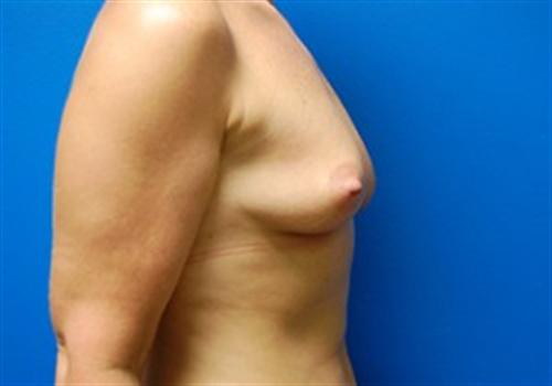 Breast Augmentation Before and After | SGK Plastic Surgery