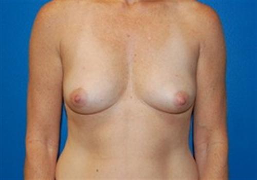 Breast Augmentation Before and After | SGK Plastic Surgery