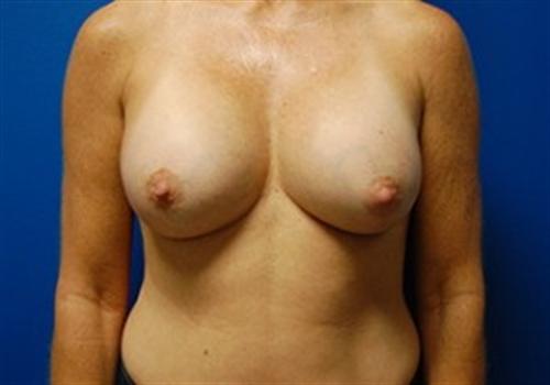 Breast Augmentation Before and After | SGK Plastic Surgery