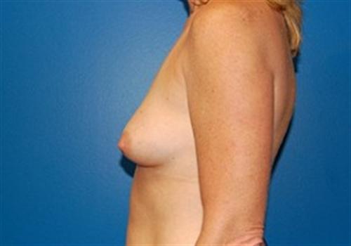 Breast Augmentation Before and After | SGK Plastic Surgery