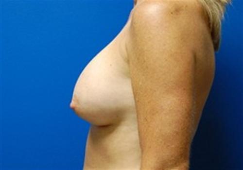 Breast Augmentation Before and After | SGK Plastic Surgery