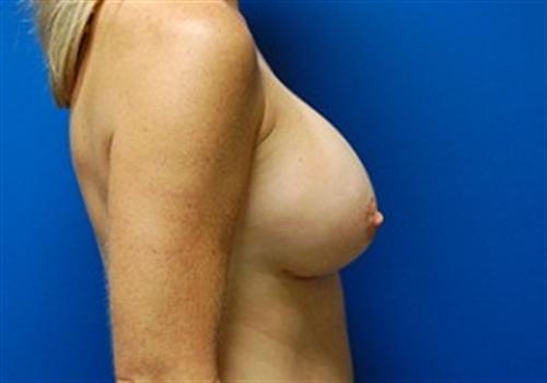 Breast Augmentation Before and After | SGK Plastic Surgery