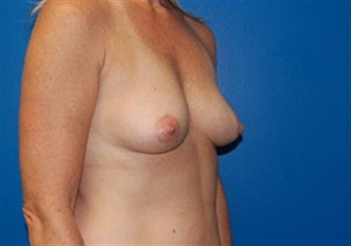 Breast Augmentation Before and After | SGK Plastic Surgery