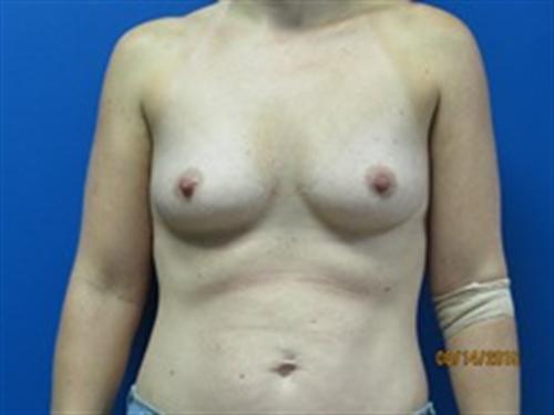 Breast Augmentation Before and After | SGK Plastic Surgery