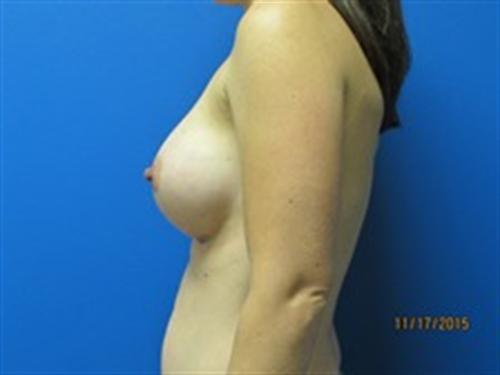 Breast Augmentation Before and After | SGK Plastic Surgery