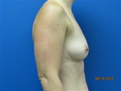 Breast Augmentation Before and After | SGK Plastic Surgery