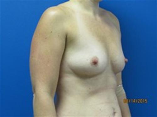 Breast Augmentation Before and After | SGK Plastic Surgery