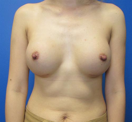 Breast Augmentation Before and After | SGK Plastic Surgery