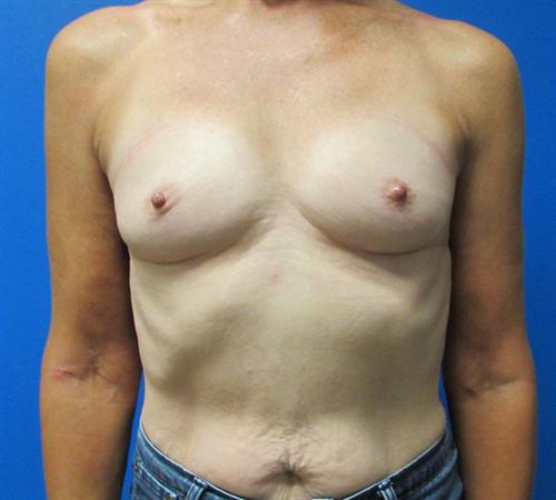 Breast Augmentation Before and After | SGK Plastic Surgery