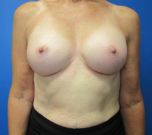 Breast Augmentation Before and After | SGK Plastic Surgery