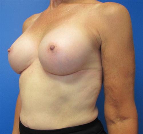 Breast Augmentation Before and After | SGK Plastic Surgery