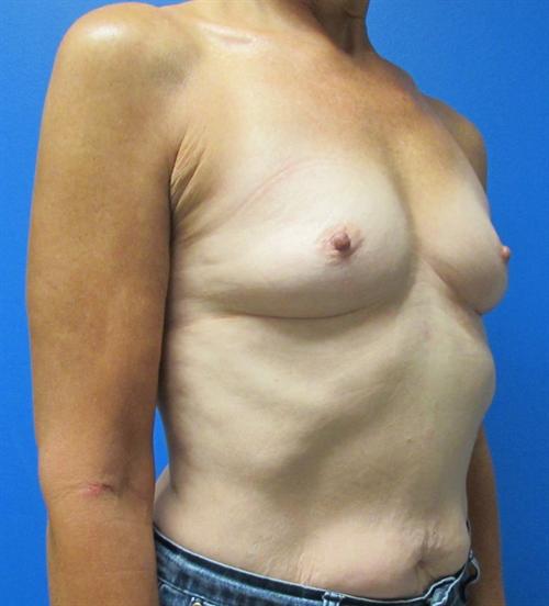 Breast Augmentation Before and After | SGK Plastic Surgery