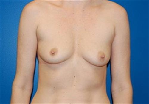 Breast Augmentation Before and After | SGK Plastic Surgery