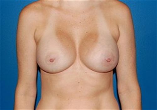 Breast Augmentation Before and After | SGK Plastic Surgery