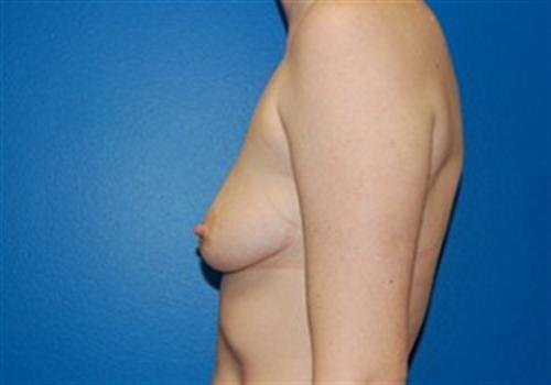 Breast Augmentation Before and After | SGK Plastic Surgery