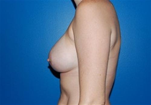 Breast Augmentation Before and After | SGK Plastic Surgery