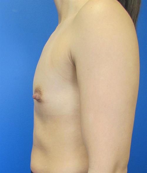 Breast Augmentation Before and After | SGK Plastic Surgery